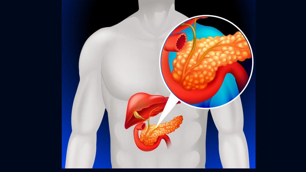 pancreatite ilustração