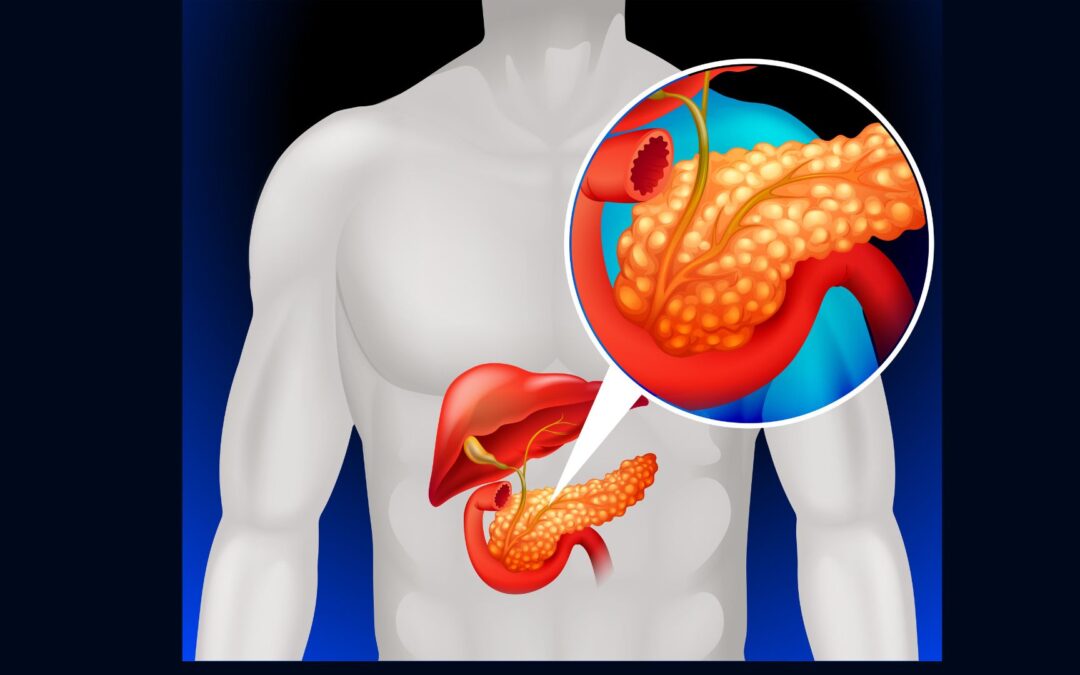 Mounjaro causa pancreatite? Entenda se existe relação