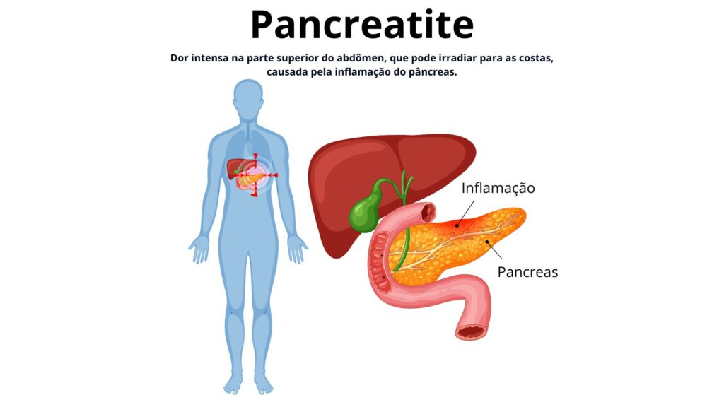 pancreatite ilustração