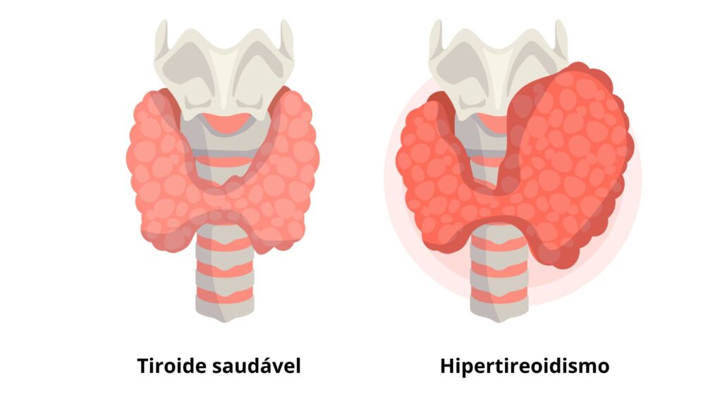 ilustração de hipertireoidismo