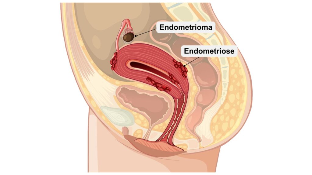 ilustracao endometrioma endometriose