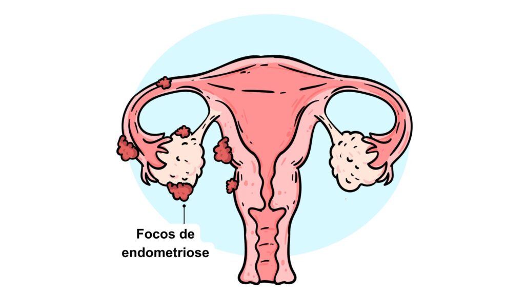 ilustração de focos de endometriose